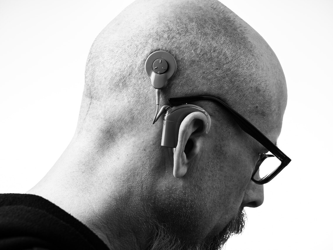 Mann mit Brille, Bart und Cochlea-Implantat am Kopf.